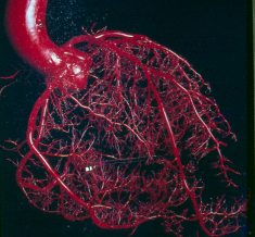An image of CORONARY ARTERY DISEASE